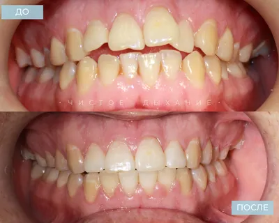 Ортодонтическое лечение на брекетах WIN с удалением зубов
