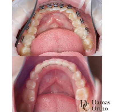 Лицо до и после брекетов - как меняется лицо после исправления прикуса