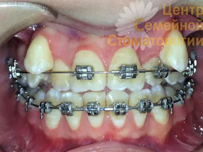 ДО и ПОСЛЕ. Как мою улыбку изменили брекет-системы | Отзывы покупателей |  Косметиста