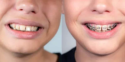 Лицо до и после брекетов - как меняется лицо после исправления прикуса