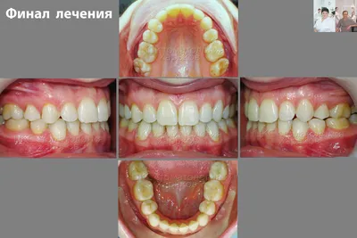 Брекеты: стоимость в Москве на установку системы под ключ на обе челюсти в  клинике стоматологии