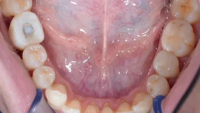 Ортодонтия. Результат за 2 года. До и после | Пикабу