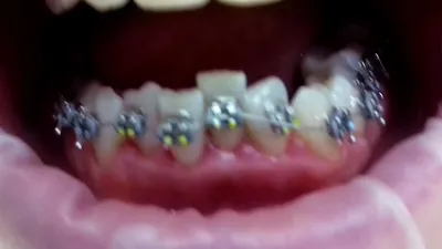 Фото до и после лечения у врача стоматолога-ортодонта Курдас С. С.