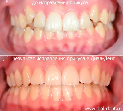Как меняется взгляд девушки после ортодонтического лечения :: NORD DENTAL —  сеть клиник семейной стоматологии на севере Петербурга