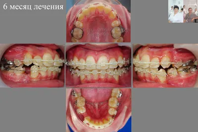 Повторное ортодонтическое лечение лингвальными брекетами WIN