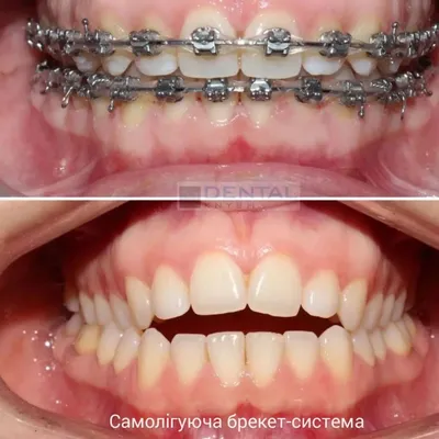 Красивая улыбка и ровные зубы после лечения брекетами.