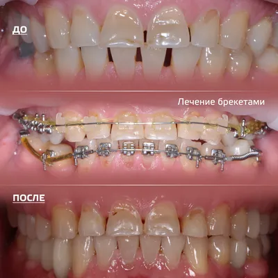 Сапфировые брекеты — установка, отзывы, фото до и после лечения сапфировой  брекет-системой