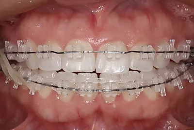 Особенности выпрямления зубов частичными брекетами