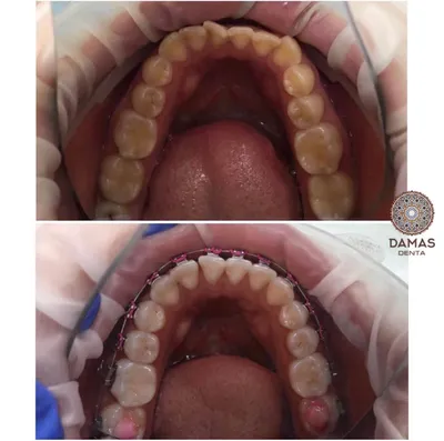 Керамические брекеты \"до и после\" 🦷 Установка брекетов в Киеве |  iStomatolog