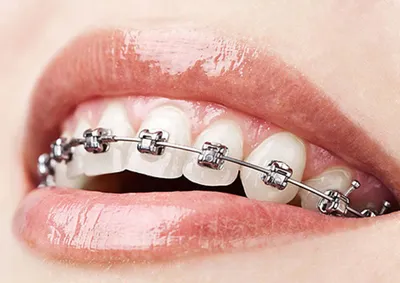 Брекеты на клыки — исправление зубов до и после — Мытищи цена и отзывы  стоматологии Best Family