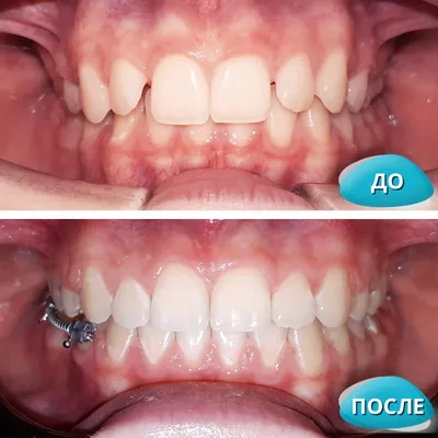 Ортодонтическое лечение на брекет-системе в Москве: цены, фото до и после,  отзывы | Стоимость ортодонтического лечения на брекет-системе в клинике  Seline