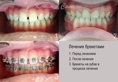 Лечение брекетами — цена, сроки и результаты | Damas Medical Center