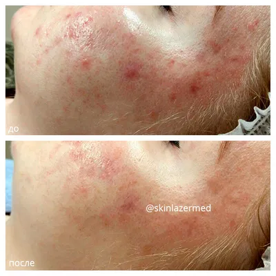Лазерное лечение акне по доступной цене в SkinLazerMed