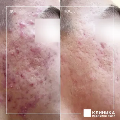 Избавиться от прыщей и расширенных пор