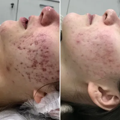Лечение акне (угрей) в Киеве | Brenner Clinic
