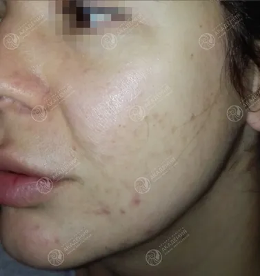Лечение акне М22 - MD Beauty Clinic