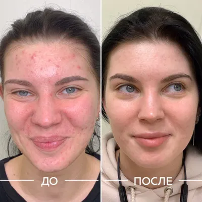 Прыщи. Ответы и решения от врача-дерматолога