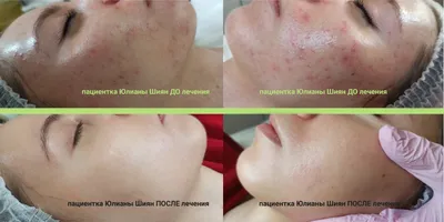 Лазерное лечение акне - удаление прыщей на лице