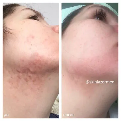 Фотолечение акне эффективный метод борьбы с АКНЕ SkinLazerMed