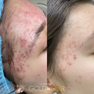 Удаление рубцов от акне в Москве в центре VersuaClinic, цены, отзывы