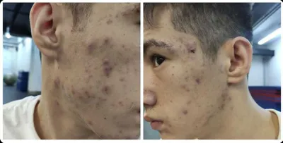 Лазерное лечение акне ClearSkin | Клиника АЛОДЕРМ Москва