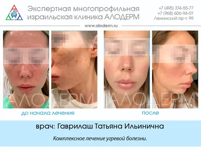 Как избавиться от постакне | Клиника эстетической медицины “Elevans”