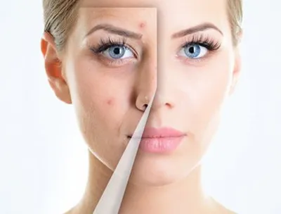 Лазерное лечение акне - COSMOPRO — Косметологическая клиника