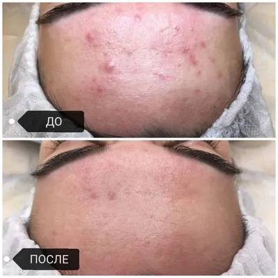 Есть акне? Есть решение! фото До и После The Ordinary Niacinamide 10% +  Zinс 1% – Сыворотка для проблемной кожи | Отзывы покупателей | Косметиста