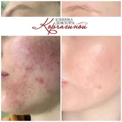 Heleo4™ в лечении вульгарных угрей - Облик. Esthetic Guide