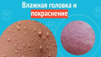 Лечение лейкоплакии головки полового члена в Москве - Арбатклиник