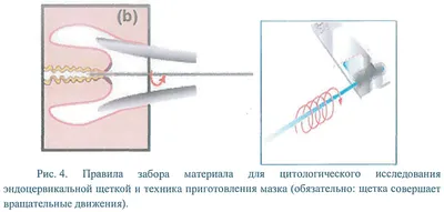 Код ICD-10: N48.0 Лейкоплакия полового члена