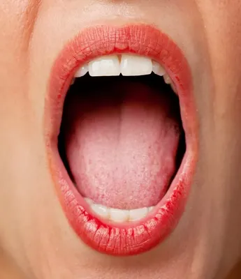 Лейкоплакия слизистой оболочки полости рта и красной каймы губ. Тактика  ведения больных на амбулаторном приеме - Клинический разбор в общей  медицине №02 2022 - CON-MED.RU