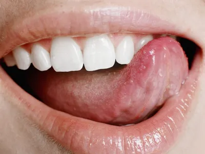 Лейкоплакия слизистой полости рта