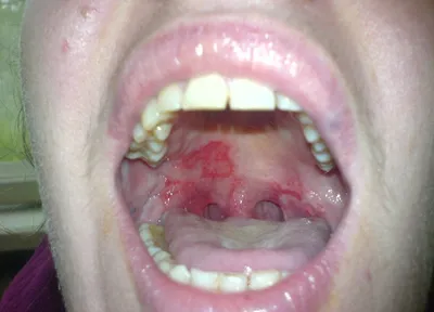 ❗️❗️❗️Лейкоплакия - это состояние, при котором на слизистой полости рта  образуются плотные, белые или сероватые пятна. ☝️☝️☝️Курение является  наиболее распространенной причиной... Легкая степень лейкоплакии обычно  безвредна и часто проходит ...