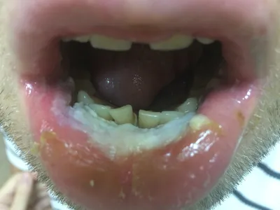 МЯГКАЯ ЛЕЙКОПЛАКИЯ: ЧТО ЭТО ТАКОЕ? ⠀⠀⠀⠀⠀⠀⠀⠀⠀⠀⠀⠀⠀⠀⠀⠀⠀⠀⠀⠀⠀⠀⠀⠀⠀⠀⠀ Это  результат хронической травмы слизистой оболочки полости рта… | Instagram