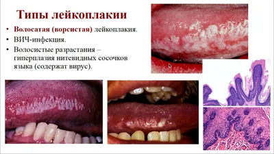 Лечение лейкоплакии полости рта