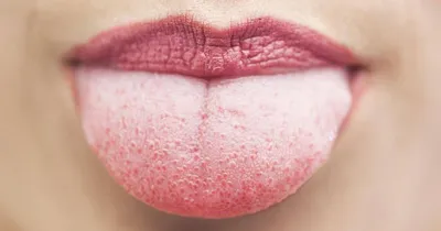 ❗️☝️Лейкоплакия полости рта считается предраковым заболеванием и выражается  в ороговении слизистой оболочки рта или каймы губ, чаще в виде белесоватого  плотного налета. У людей, страдающих никотиновой зависимостью, встречается  никотиновая ...
