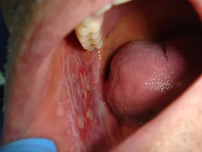 Лечение лейкоплакии полости рта — 5 эффективных методов