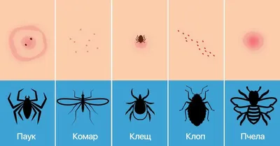 Постельные клопы, укусы и как избавиться от клопов в квартире