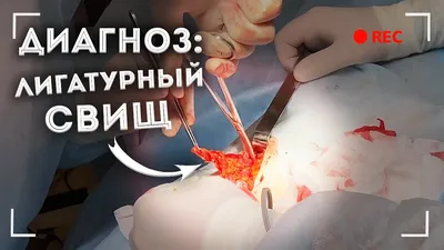 Лигатурный свищ. - обсуждение на форуме НГС Новосибирск