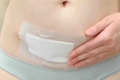 Лигатурный свищ. (Красное пятно возле шва) — 2 ответов | форум Babyblog