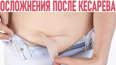 Лигатурный свищ. - обсуждение на форуме НГС Новосибирск