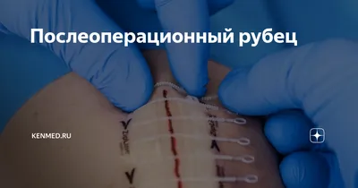 Бандаж хирургический послеоперационный С-4