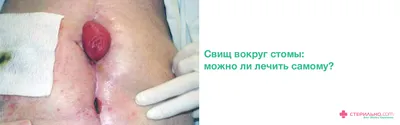 Свищ после операции на шве: как вылечить? Какими антибиотиками и народными  средствами лечить послеоперационный свищ на ноге, брюшной полости, животе после  Кесарева сечения, родов, аппендицита? Операция по иссечению  послеоперационного свища