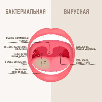 Разрастание ткани в горле