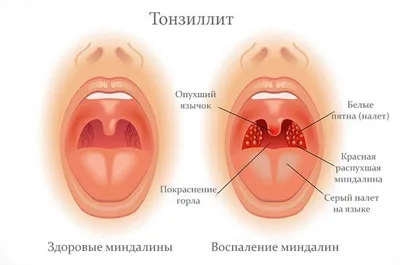 Тонзиллит острый и хронический: лечение тонзиллита у взрослого и ребенка