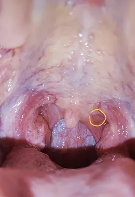 Разрастание лимфоидной ткани в горле - Вопрос лору - 03 Онлайн