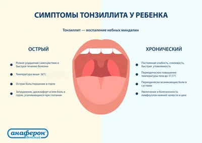 Хронический тонзиллит — причины, симптомы, осложнения, профилактика,  диагностика и лечение в 100med