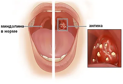 Тонзиллит у детей: симптомы, методы диагностики и лечения острого и  хронического тонзиллита в ДМЦ