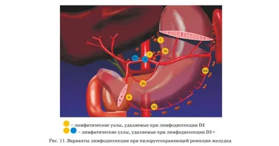 Рак желудка: практические рекомендации - лечение в Москве в Университетской  клинике МГУ им. М.В. Ломоносова